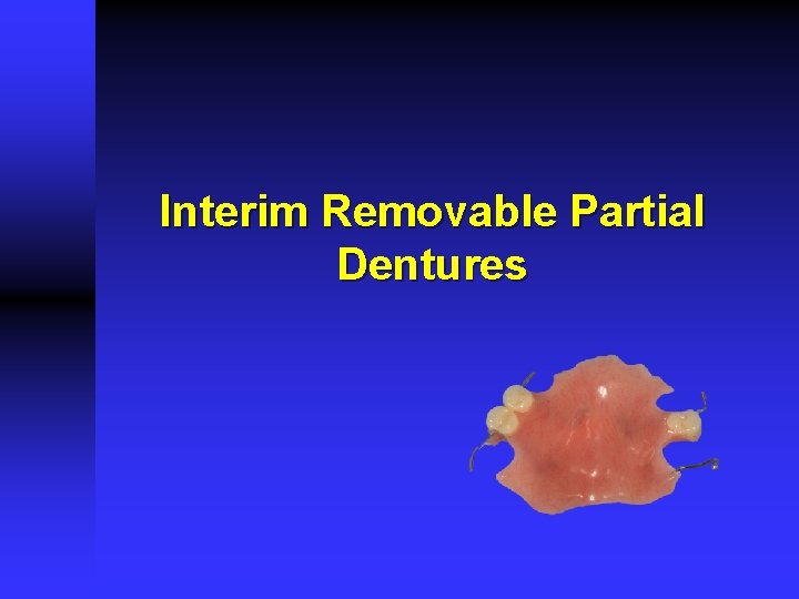 Interim Removable Partial Dentures 