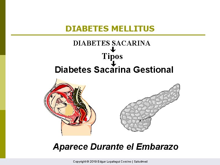 DIABETES MELLITUS DIABETES SACARINA Tipos Diabetes Sacarina Gestional Aparece Durante el Embarazo Copyright ©