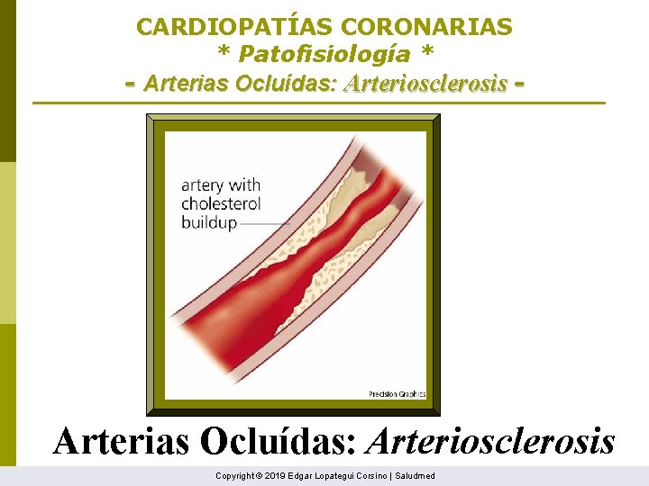 CARDIOPATÍAS CORONARIAS * Patofisiología * - Arterias Ocluídas: Arteriosclerosis Copyright © 2019 Edgar Lopategui