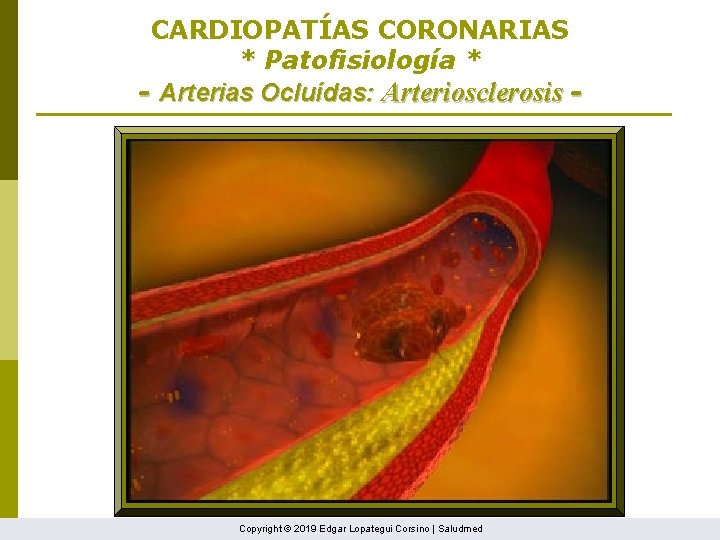 CARDIOPATÍAS CORONARIAS * Patofisiología * - Arterias Ocluídas: Arteriosclerosis - Copyright © 2019 Edgar
