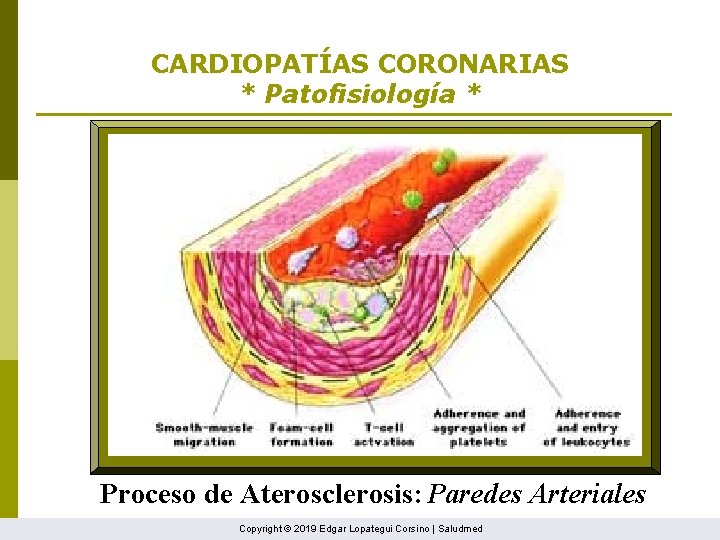 CARDIOPATÍAS CORONARIAS * Patofisiología * Proceso de Aterosclerosis: Paredes Arteriales Copyright © 2019 Edgar