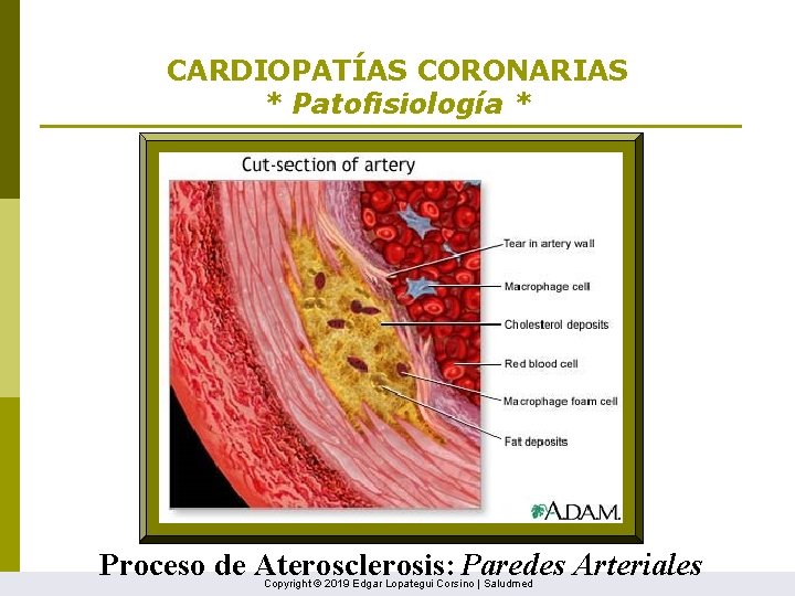 CARDIOPATÍAS CORONARIAS * Patofisiología * Proceso de Aterosclerosis: Paredes Arteriales Copyright © 2019 Edgar