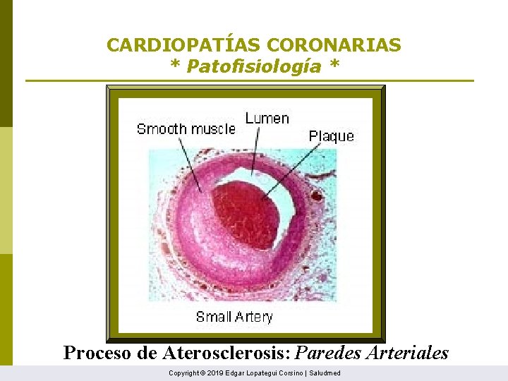 CARDIOPATÍAS CORONARIAS * Patofisiología * Proceso de Aterosclerosis: Paredes Arteriales Copyright © 2019 Edgar