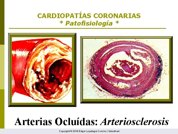 CARDIOPATÍAS CORONARIAS * Patofisiología * Arterias Ocluídas: Arteriosclerosis Copyright © 2019 Edgar Lopategui Corsino