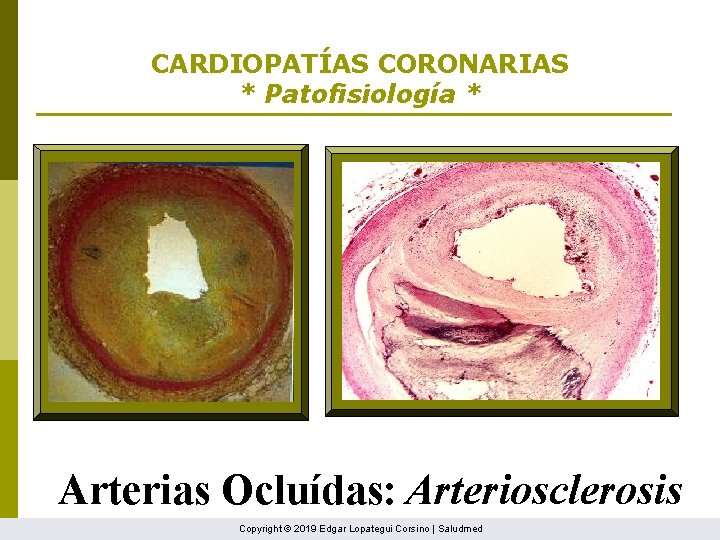 CARDIOPATÍAS CORONARIAS * Patofisiología * Arterias Ocluídas: Arteriosclerosis Copyright © 2019 Edgar Lopategui Corsino