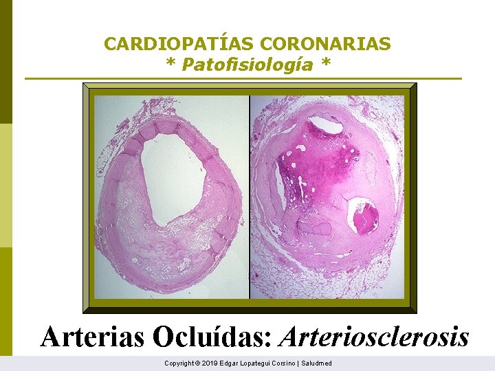 CARDIOPATÍAS CORONARIAS * Patofisiología * Arterias Ocluídas: Arteriosclerosis Copyright © 2019 Edgar Lopategui Corsino