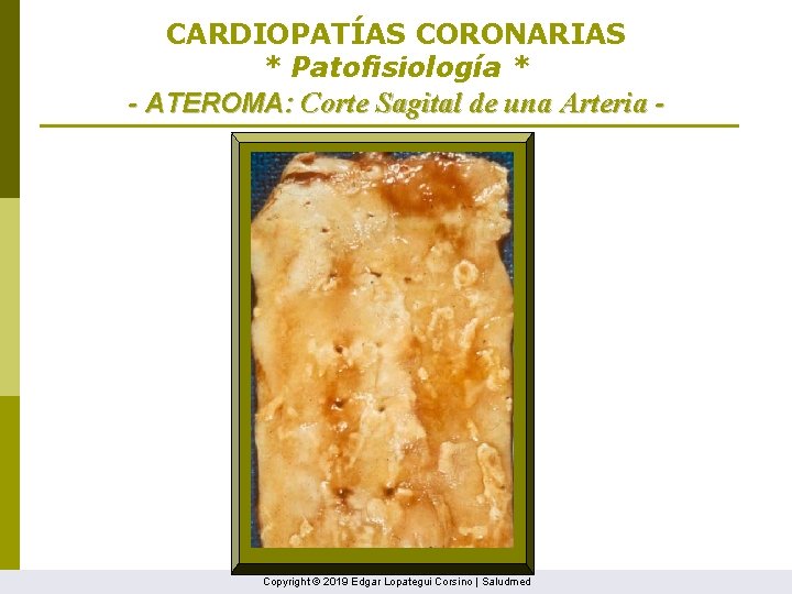 CARDIOPATÍAS CORONARIAS * Patofisiología * - ATEROMA: Corte Sagital de una Arteria - Copyright