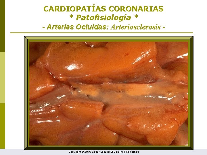 CARDIOPATÍAS CORONARIAS * Patofisiología * - Arterias Ocluídas: Arteriosclerosis - Copyright © 2019 Edgar