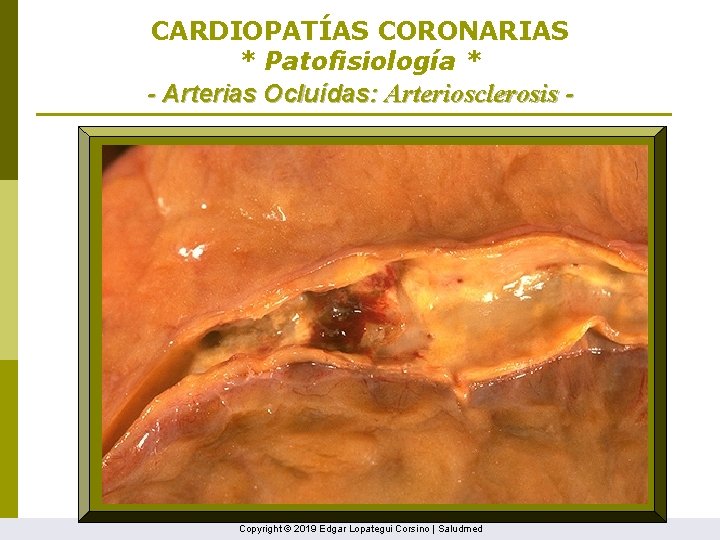 CARDIOPATÍAS CORONARIAS * Patofisiología * - Arterias Ocluídas: Arteriosclerosis - Copyright © 2019 Edgar