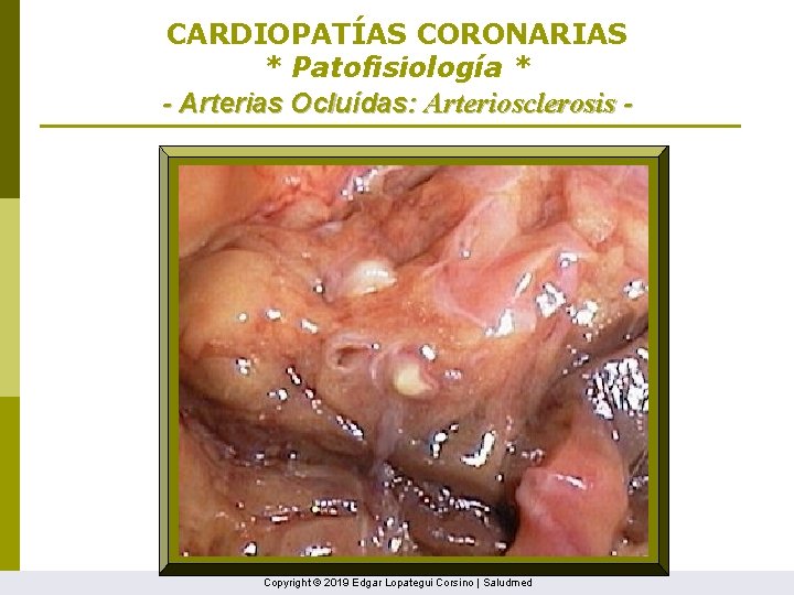 CARDIOPATÍAS CORONARIAS * Patofisiología * - Arterias Ocluídas: Arteriosclerosis - Copyright © 2019 Edgar