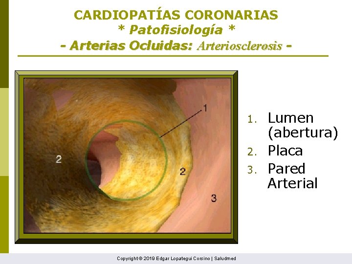 CARDIOPATÍAS CORONARIAS * Patofisiología * - Arterias Ocluidas: Arteriosclerosis - 1. 2. 3. Copyright