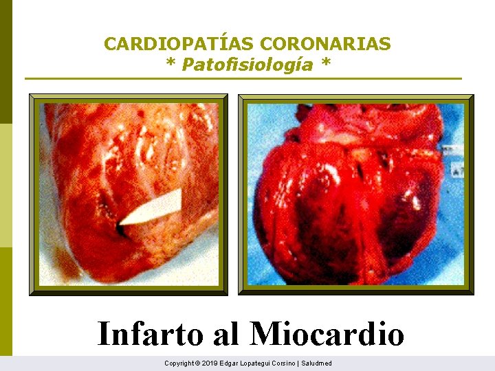 CARDIOPATÍAS CORONARIAS * Patofisiología * Infarto al Miocardio Copyright © 2019 Edgar Lopategui Corsino