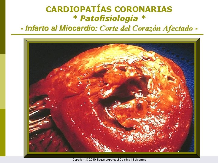 CARDIOPATÍAS CORONARIAS * Patofisiología * - Infarto al Miocardio: Corte del Corazón Afectado -