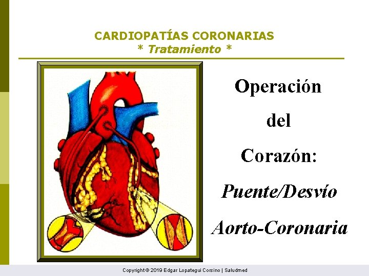 CARDIOPATÍAS CORONARIAS * Tratamiento * Operación del Corazón: Puente/Desvío Aorto-Coronaria Copyright © 2019 Edgar