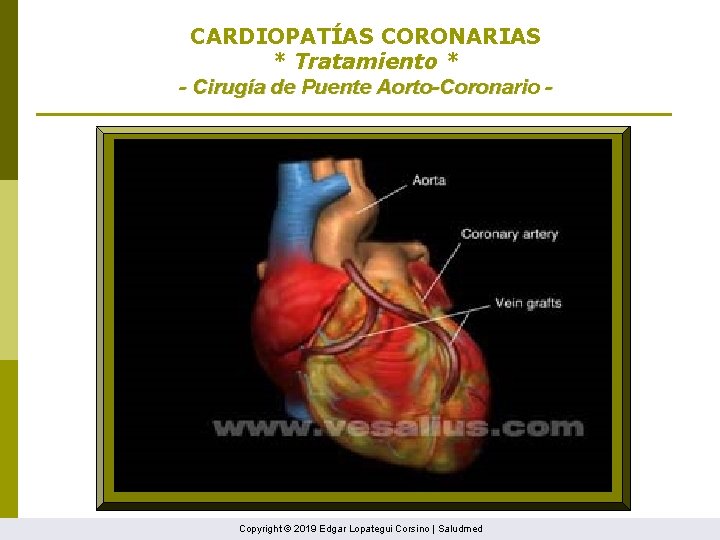 CARDIOPATÍAS CORONARIAS * Tratamiento * - Cirugía de Puente Aorto-Coronario - Copyright © 2019