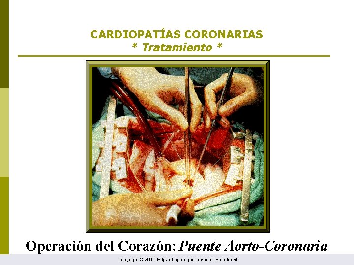 CARDIOPATÍAS CORONARIAS * Tratamiento * Operación del Corazón: Puente Aorto-Coronaria Copyright © 2019 Edgar