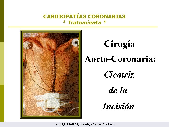 CARDIOPATÍAS CORONARIAS * Tratamiento * Cirugía Aorto-Coronaria: Cicatriz de la Incisión Copyright © 2019