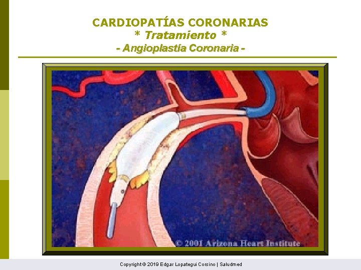 CARDIOPATÍAS CORONARIAS * Tratamiento * - Angioplastía Coronaria - Copyright © 2019 Edgar Lopategui