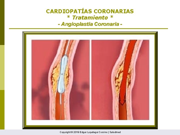 CARDIOPATÍAS CORONARIAS * Tratamiento * - Angioplastía Coronaria - Copyright © 2019 Edgar Lopategui