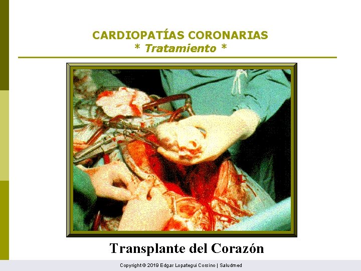 CARDIOPATÍAS CORONARIAS * Tratamiento * Transplante del Corazón Copyright © 2019 Edgar Lopategui Corsino