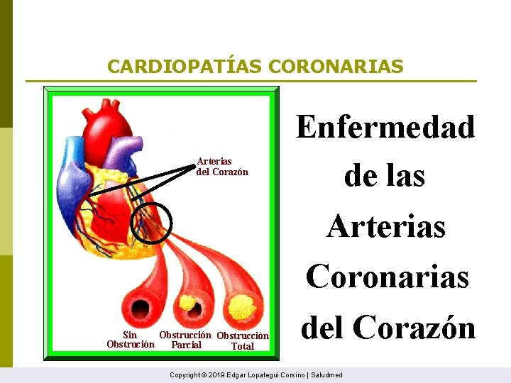 CARDIOPATÍAS CORONARIAS Arterias del Corazón Sin Obstrucción Obstrución Parcial Total Enfermedad de las Arterias