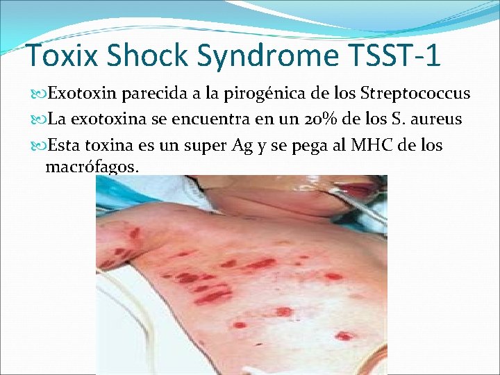 Toxix Shock Syndrome TSST-1 Exotoxin parecida a la pirogénica de los Streptococcus La exotoxina Toxix Shock Syndrome TSST-1 Exotoxin parecida a la pirogénica de los Streptococcus La exotoxina