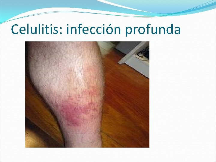 Celulitis: infección profunda Celulitis: infección profunda