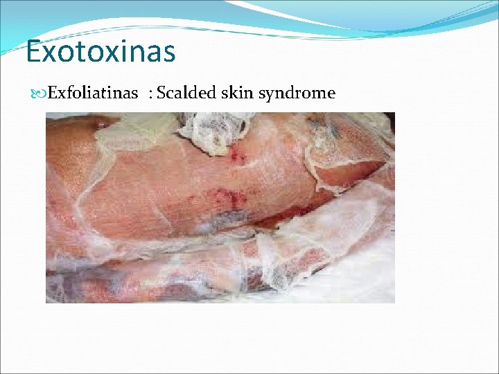 Exotoxinas Exfoliatinas : Scalded skin syndrome Exotoxinas Exfoliatinas : Scalded skin syndrome