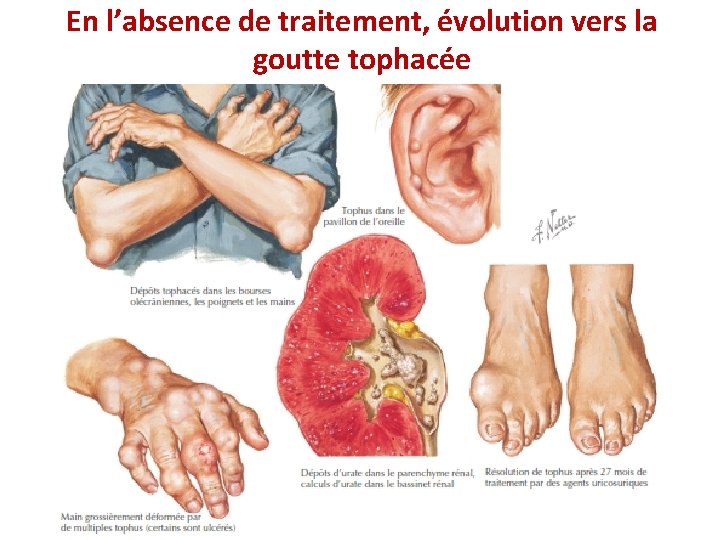 En l’absence de traitement, évolution vers la goutte tophacée En l’absence de traitement, évolution vers la goutte tophacée