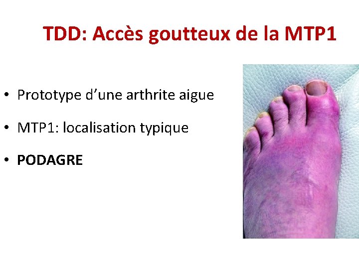 TDD: Accès goutteux de la MTP 1 • Prototype d’une arthrite aigue • MTP TDD: Accès goutteux de la MTP 1 • Prototype d’une arthrite aigue • MTP