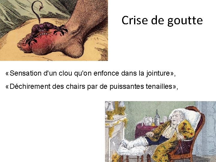 Crise de goutte «Sensation d'un clou qu'on enfonce dans la jointure» , «Déchirement des Crise de goutte «Sensation d'un clou qu'on enfonce dans la jointure» , «Déchirement des
