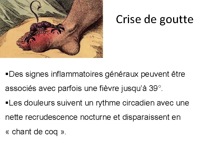 Crise de goutte §Des signes inflammatoires généraux peuvent être associés avec parfois une fièvre Crise de goutte §Des signes inflammatoires généraux peuvent être associés avec parfois une fièvre