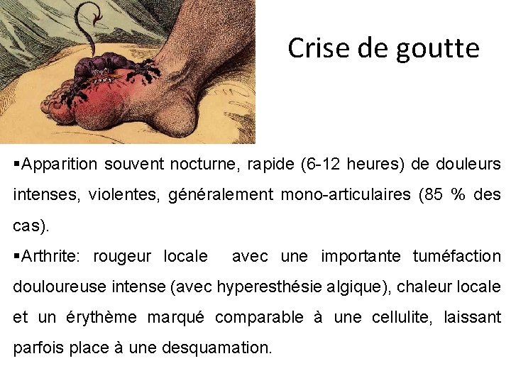 Crise de goutte §Apparition souvent nocturne, rapide (6 -12 heures) de douleurs intenses, violentes, Crise de goutte §Apparition souvent nocturne, rapide (6 -12 heures) de douleurs intenses, violentes,