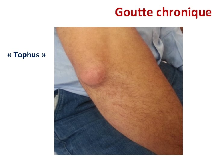 Goutte chronique « Tophus » Goutte chronique « Tophus »