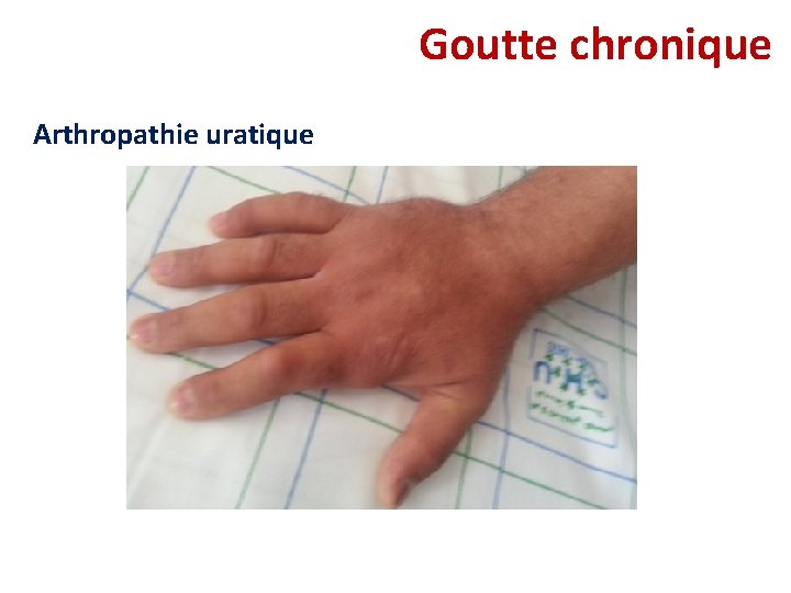 Goutte chronique Arthropathie uratique Goutte chronique Arthropathie uratique