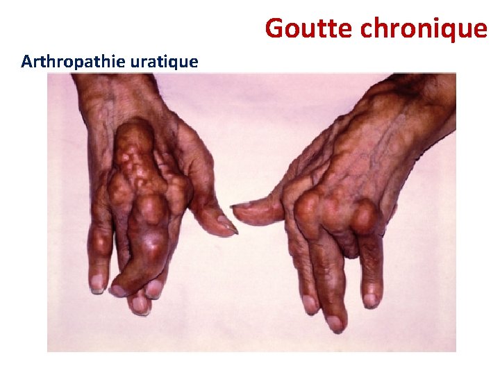 Goutte chronique Arthropathie uratique Goutte chronique Arthropathie uratique