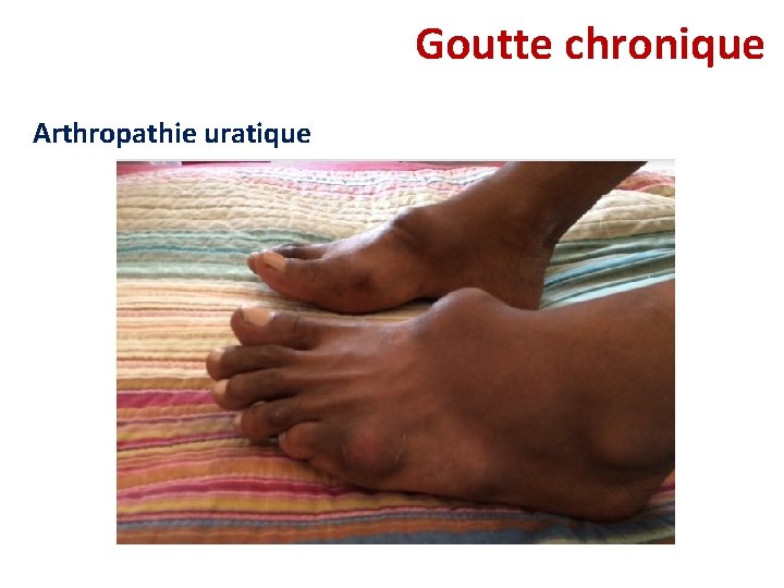 Goutte chronique Arthropathie uratique Goutte chronique Arthropathie uratique
