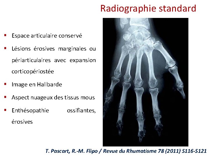Radiographie standard § Espace articulaire conservé § Lésions érosives marginales ou périarticulaires avec expansion Radiographie standard § Espace articulaire conservé § Lésions érosives marginales ou périarticulaires avec expansion