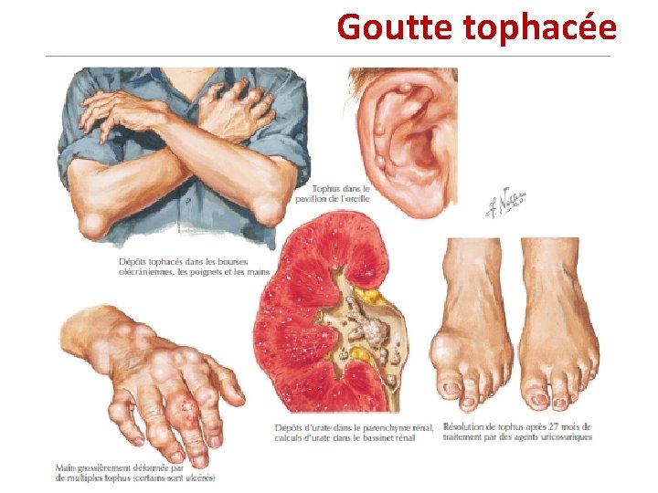 Goutte tophacée Goutte tophacée