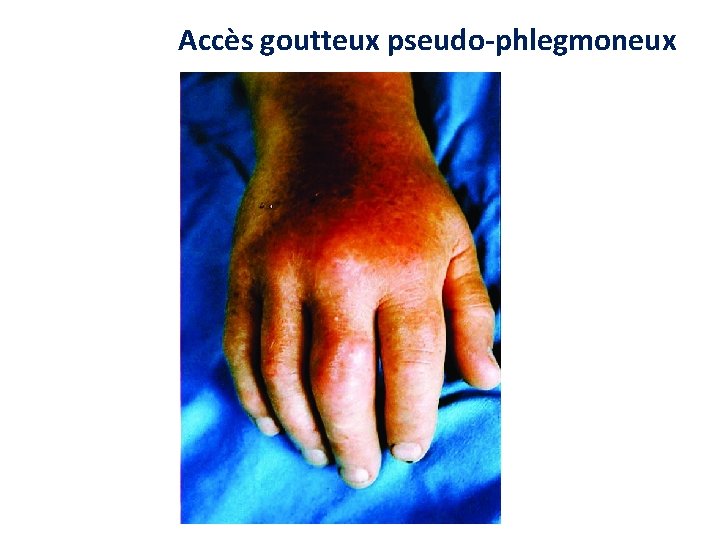 Accès goutteux pseudo-phlegmoneux Accès goutteux pseudo-phlegmoneux
