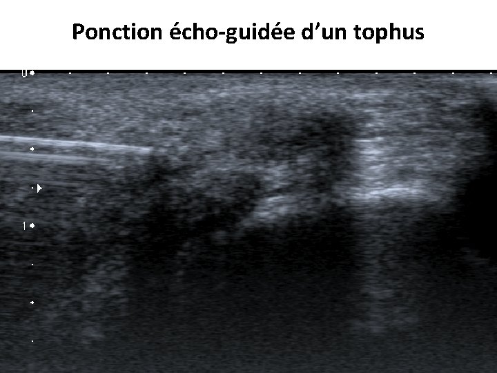 Ponction écho-guidée d’un tophus Ponction écho-guidée d’un tophus