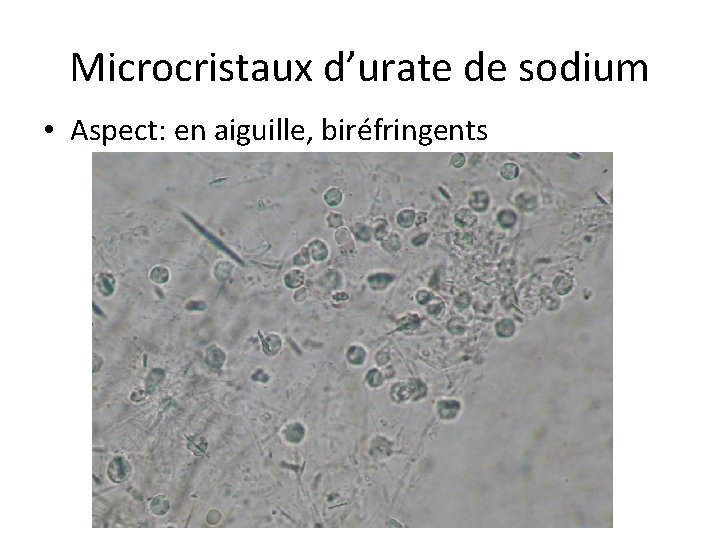 Microcristaux d’urate de sodium • Aspect: en aiguille, biréfringents Microcristaux d’urate de sodium • Aspect: en aiguille, biréfringents