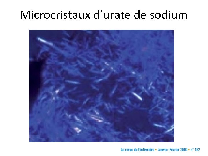 Microcristaux d’urate de sodium Microcristaux d’urate de sodium