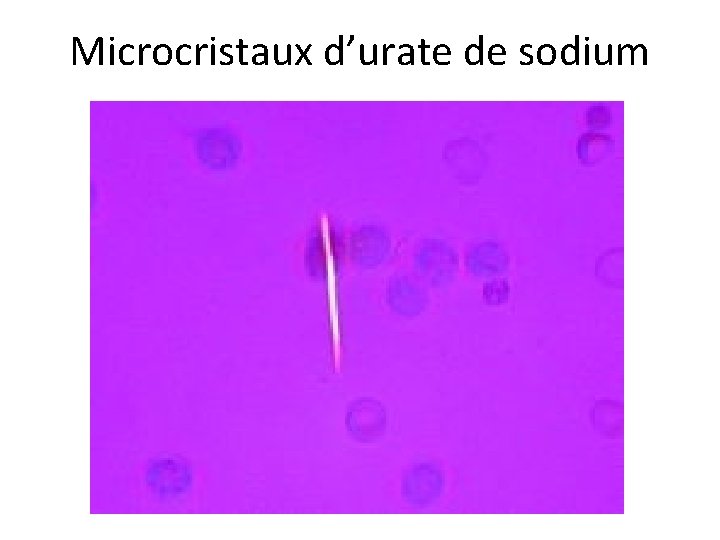 Microcristaux d’urate de sodium Microcristaux d’urate de sodium