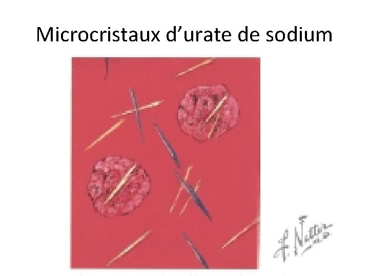 Microcristaux d’urate de sodium Microcristaux d’urate de sodium