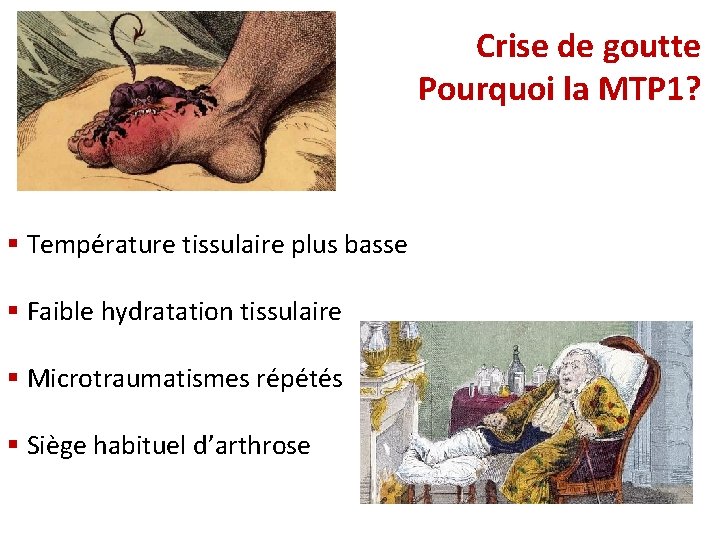 Crise de goutte Pourquoi la MTP 1? § Température tissulaire plus basse § Faible Crise de goutte Pourquoi la MTP 1? § Température tissulaire plus basse § Faible