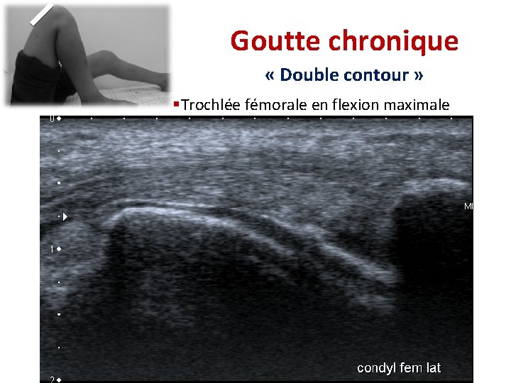 Goutte chronique « Double contour » §Trochlée fémorale en flexion maximale Goutte chronique « Double contour » §Trochlée fémorale en flexion maximale