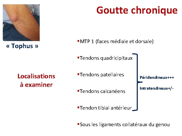 Goutte chronique « Tophus » §MTP 1 (faces médiale et dorsale) §Tendons quadricipitaux Localisations Goutte chronique « Tophus » §MTP 1 (faces médiale et dorsale) §Tendons quadricipitaux Localisations