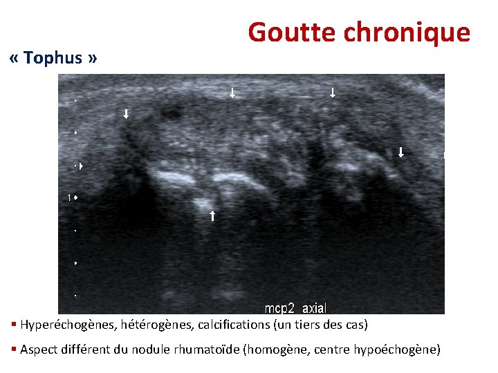 « Tophus » Goutte chronique § Hyperéchogènes, hétérogènes, calcifications (un tiers des cas) « Tophus » Goutte chronique § Hyperéchogènes, hétérogènes, calcifications (un tiers des cas)