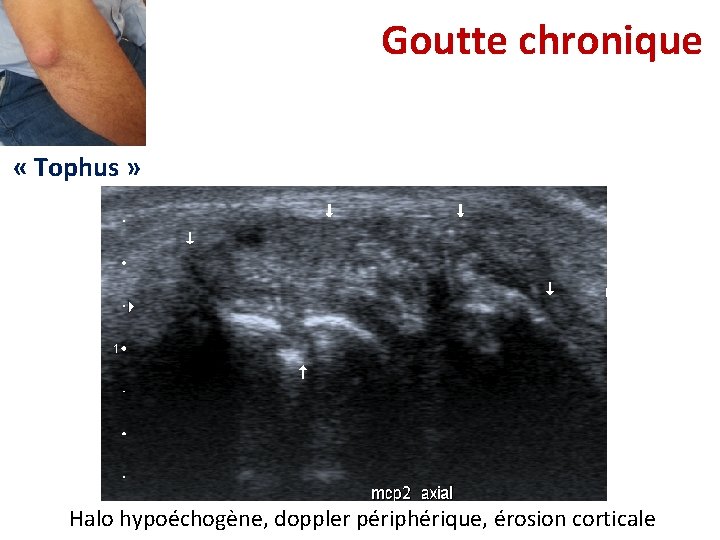 Goutte chronique « Tophus » Halo hypoéchogène, doppler périphérique, érosion corticale Goutte chronique « Tophus » Halo hypoéchogène, doppler périphérique, érosion corticale